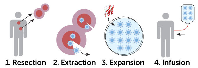 A graphic showing four steps: 1. Resection, 2. Extraction, 3. Expansion, 4. Infusion